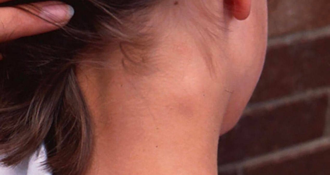 boyunda olusan sislikler ciddi hastalik belirtisi olabilir J7As42Ma